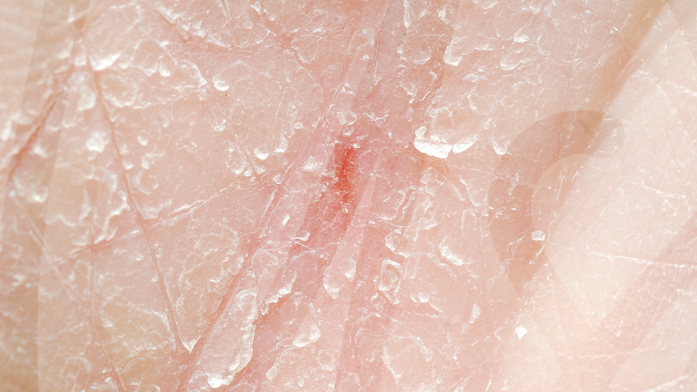 Close-up of a face with dry, flaky skin, highlighting the common symptoms of dry skin conditions.